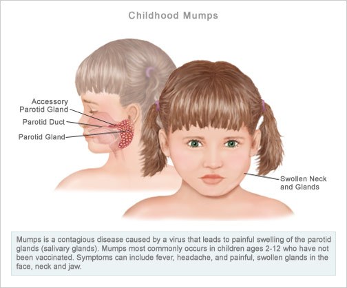Mumps; Parotitis, Epidemic