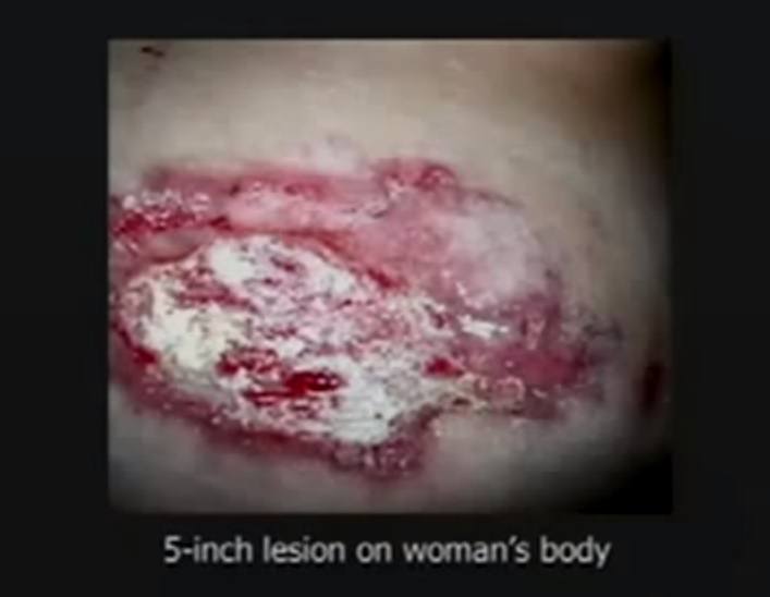 Morgellons-5-inch-lesion
