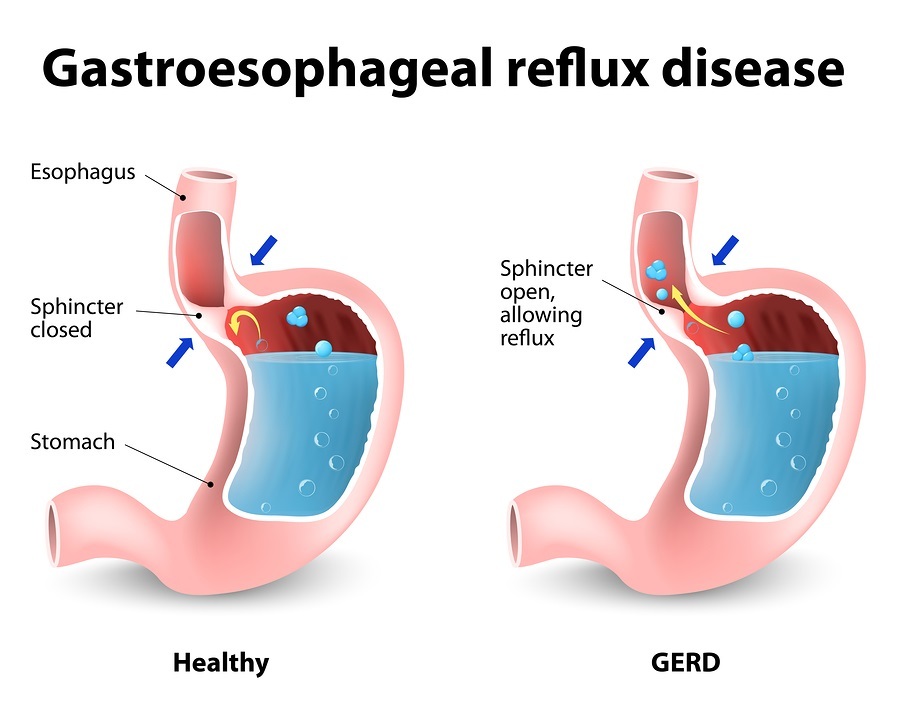 Heartburn and Gastroesophageal Reflux Disease (GERD). The stomach 