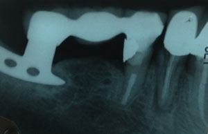 Image shows a root canal treated tooth anchoring one side of a bridge, an implant anchoring the other side