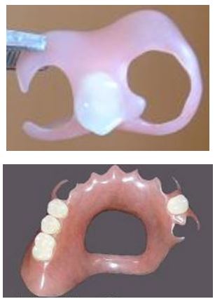 The intentional exposed palate design in this partial means the wearer can continue good oral posture, which means properly keep the tongue in contact with the palate