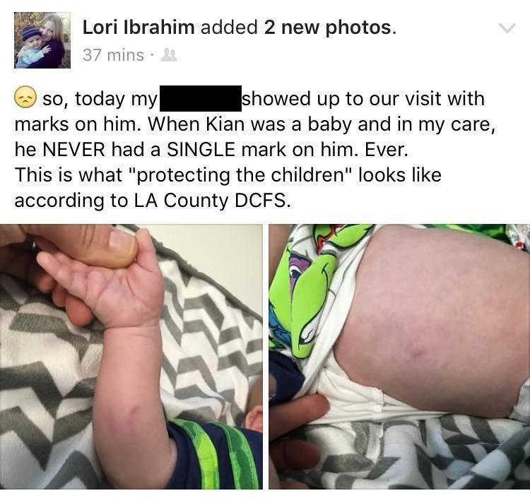 Lori-Ibrahim-bruise-photos2