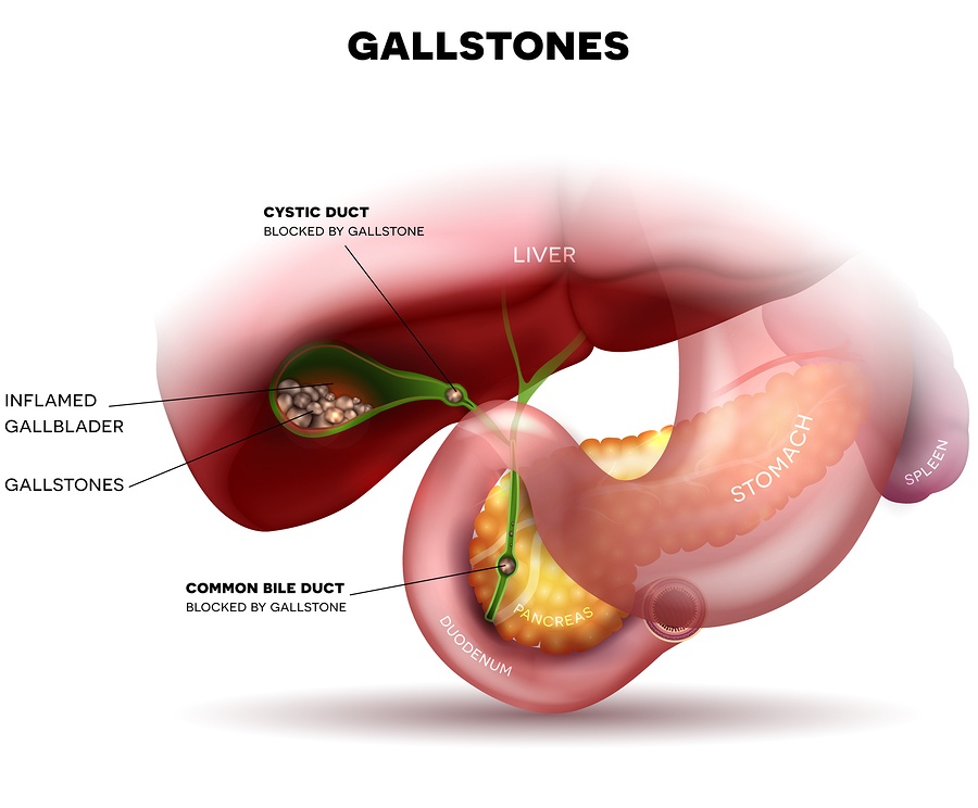 Stones in the Gallbladder and anatomy of other surrounding organs