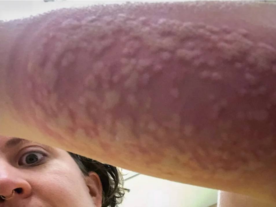 Carolina Reid mosquito bites