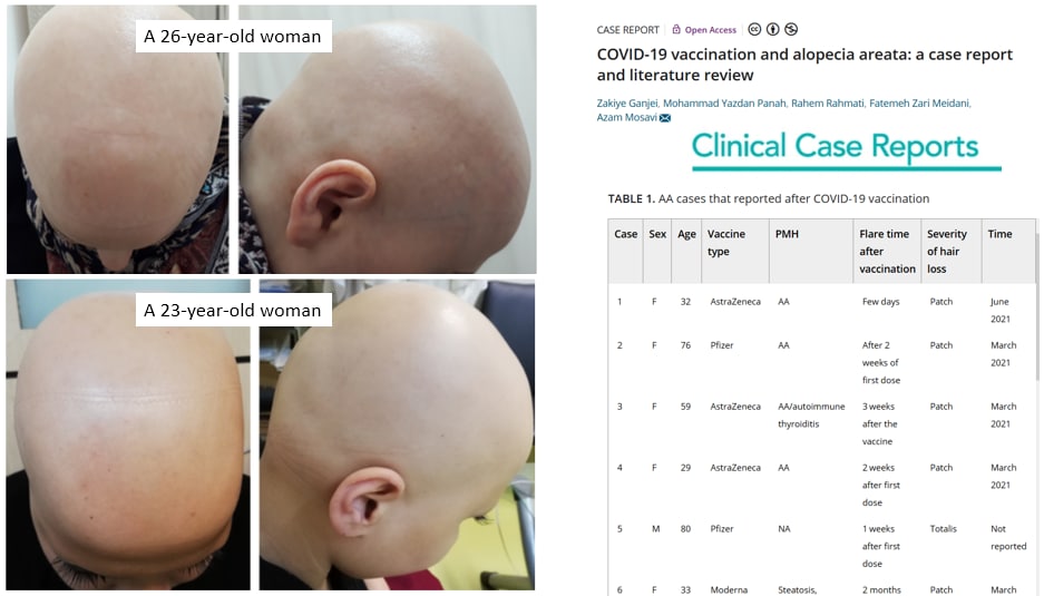 Hair loss after COVID vaccines